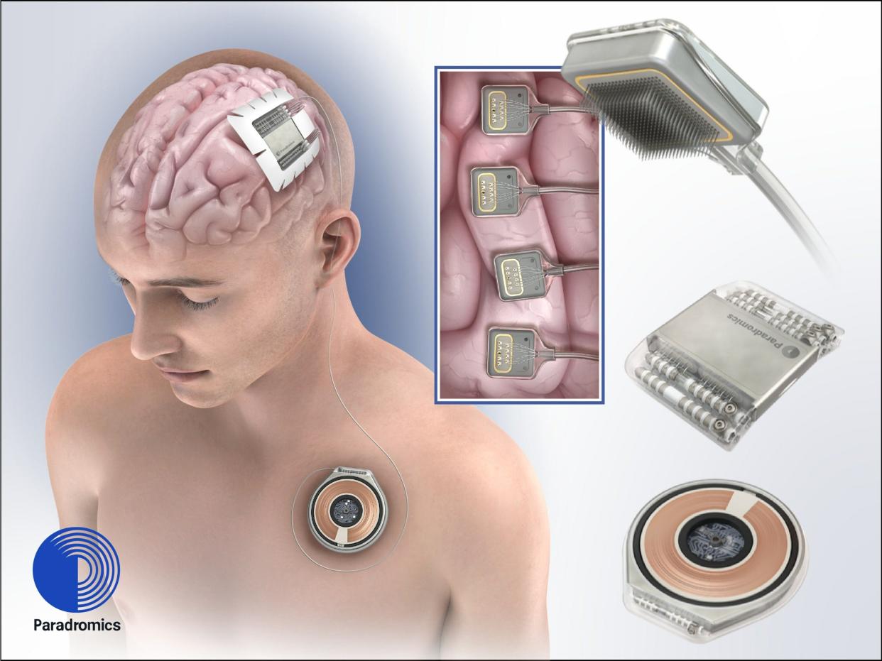 Paradromics, is making brain computer interfaces, an emerging technology expected to help people with paralysis communicate. The company's device records signals from neurons in the brain, and transmits them through a device that sits under the skin in the chest. Th