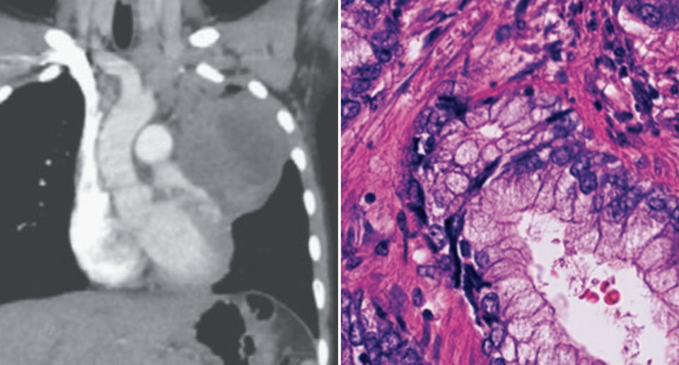 The lungs of a boy, 6, are seen alongside a tumour taken from the cervix of his mum. Source: New England Journal of Medicine