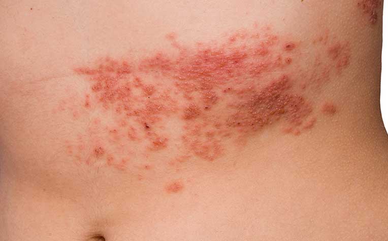 Shingles: First Signs and Causes