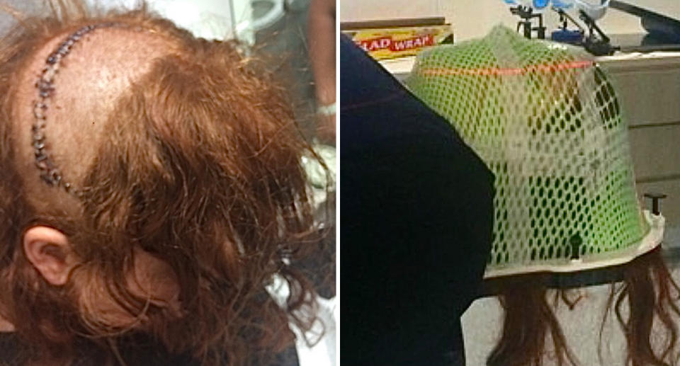 Left: A large scar can be seen on Anna's scalp. Right: Anna lies on a medical bed with a mask covering her face as she undergoes radiation therapy. 