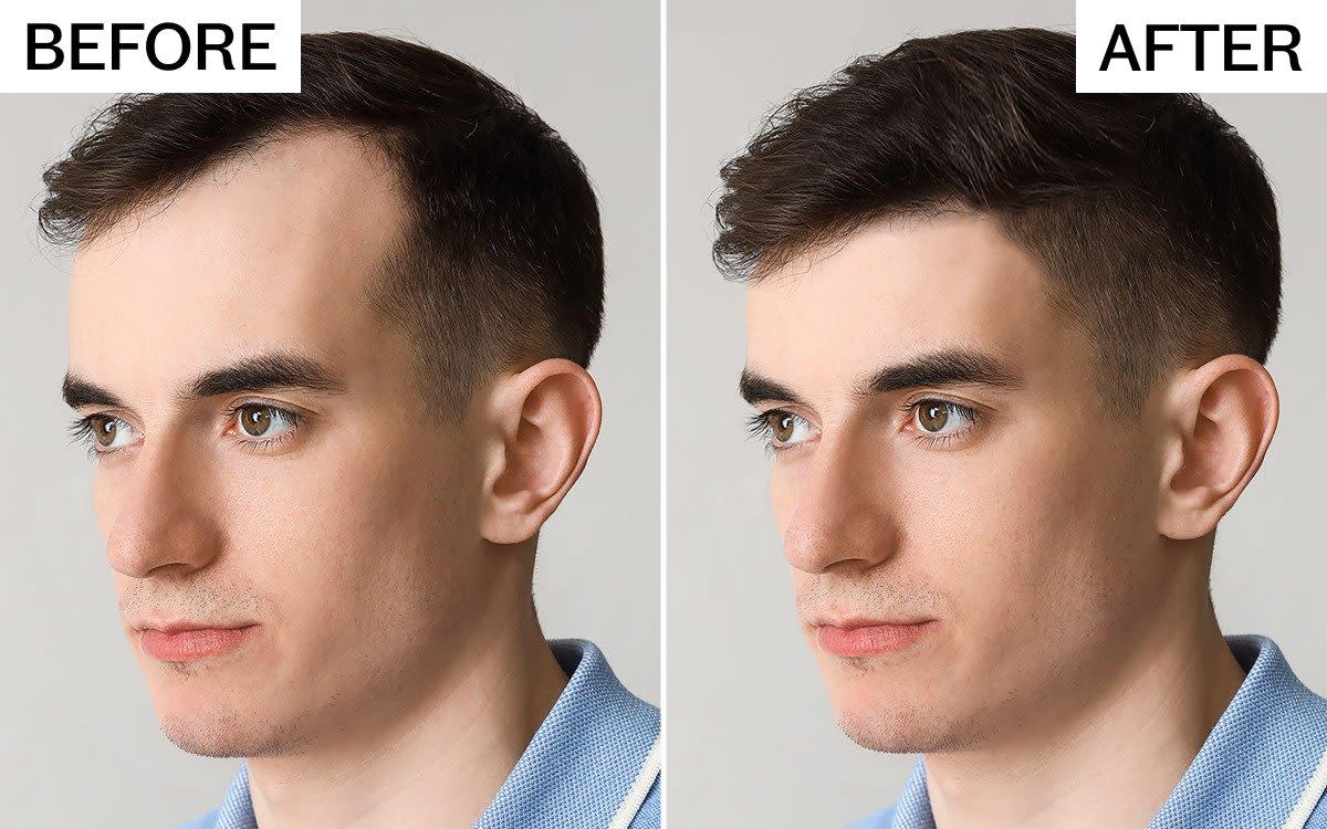 hair loss before and after