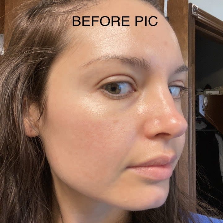 Krista Torres' skin before the laser treatment.