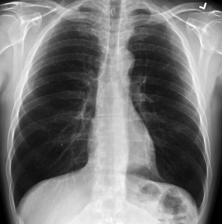 一般健康者的肺部X光照，呈現非常乾淨的黑色。（圖／翻攝自NewsNation）