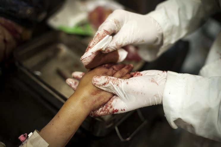 A Syrian girl is treated for her injuries suffered from shelling in Aleppo. (Photo: AP)