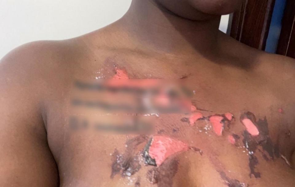 PHOTO: Tahjana Lewis reportedly suffered from 'severe' and 'disfiguring' burns on her upper chest, breasts, legs, left buttocks and right arm, according to a complaint filed in June. (Courtesy Tahjana Lewis )