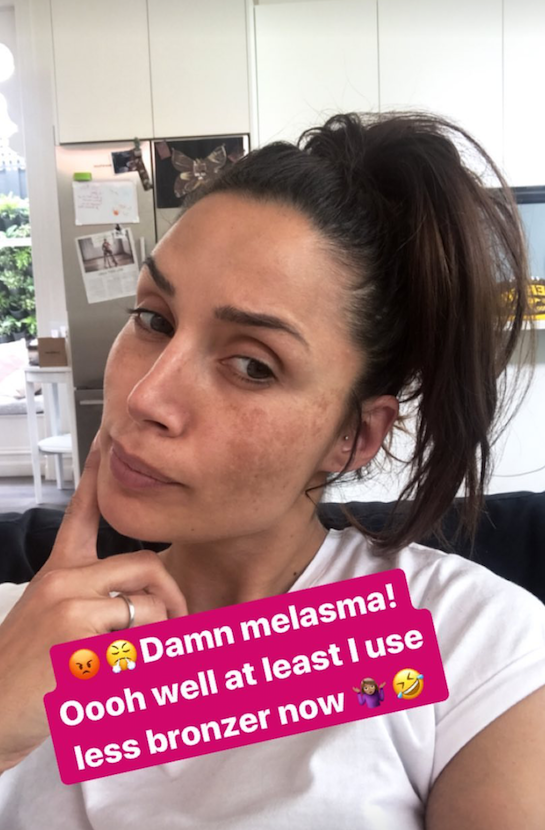 She's known for looking flawless but Snez has some post-baby skin issues. Photo: Instagram