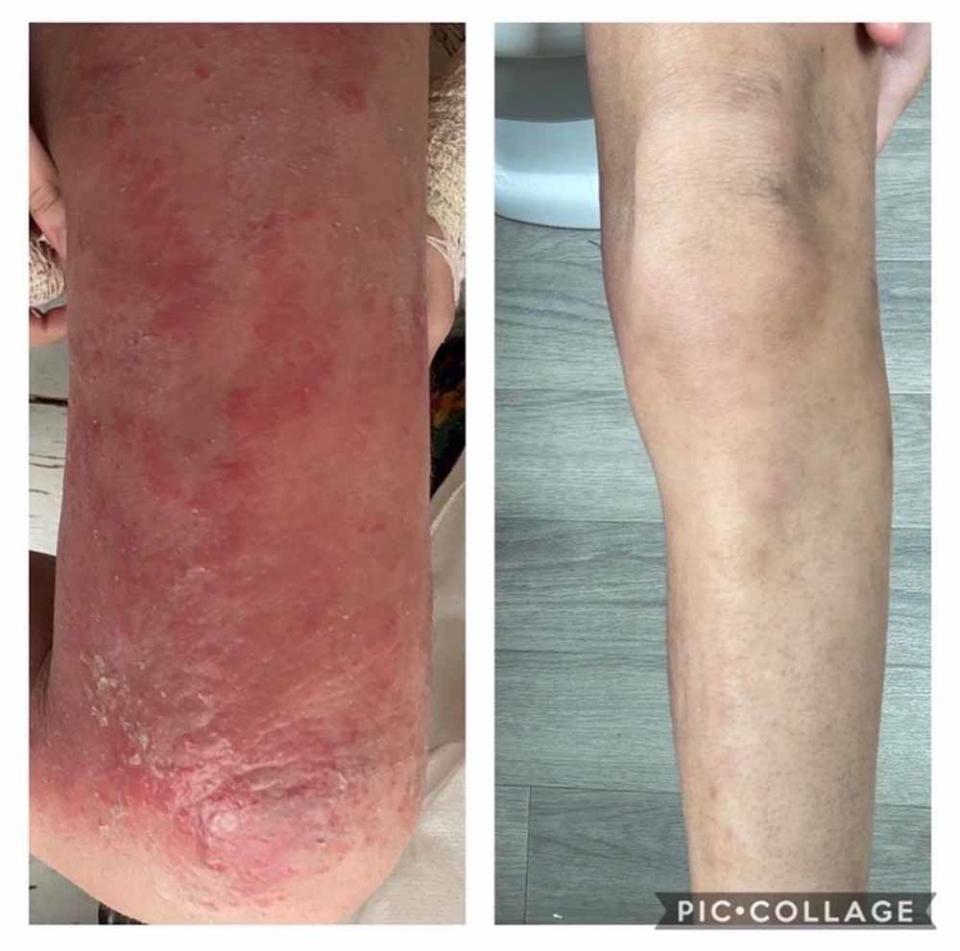 Scarlet’s legs and knees became red and sore. PA REAL LIFE COLLECT