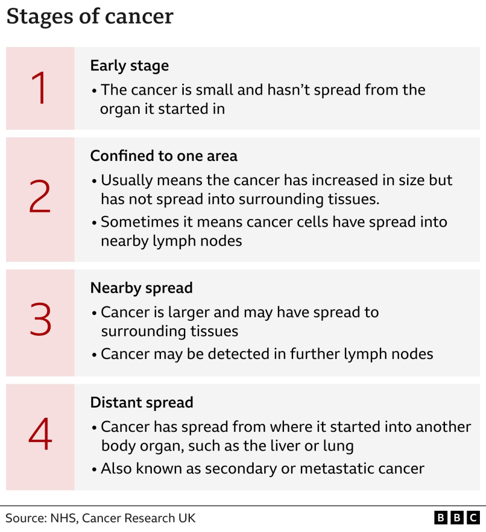 A graphic showing the stages of cancer. First stage: This is the early stage when the cancer is small and hasn't spread from the organ it started in; Second stage: When it is confined to one area, which usually means the cancer has increased in size but has not spread into surrounding tissues - sometimes it means cancer cells have spread into nearby lymph nodes; Third stage: This is when the cancer is larger and may have spread to surrounding tissues; Fourth stage: When the cancer has spread from where it started into another body organ, such as the liver or lung.