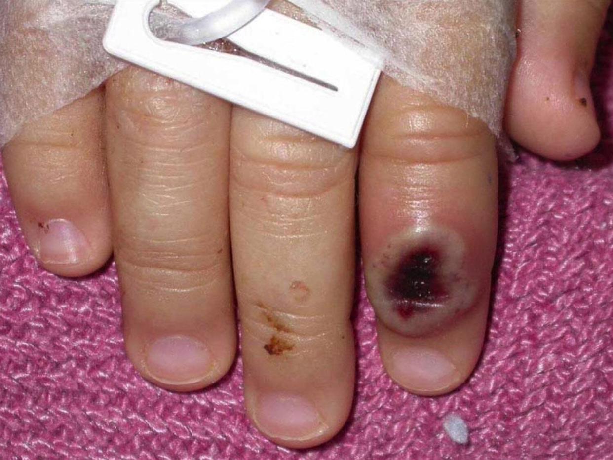 Monkeypox infected finger, photo