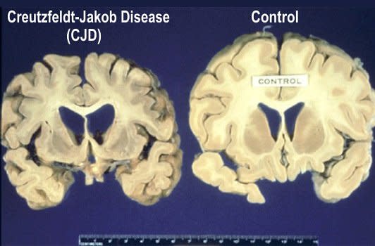 Creutzfeldt-Jakob disease (CJD)