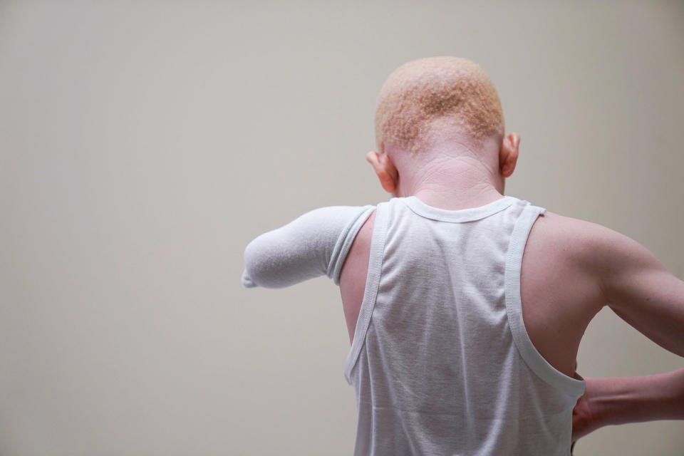 <p>Mwigulu Magesaa 14, a Tanzanian with albinism who had an arm chopped off in a witchcraft-driven attack, waits in an examination room during a prosthetic fitting at the Shriners Hospital in Philadelphia, Pa., on May 30, 2017. (Photo: Carlo Allegri/Reuters) </p>