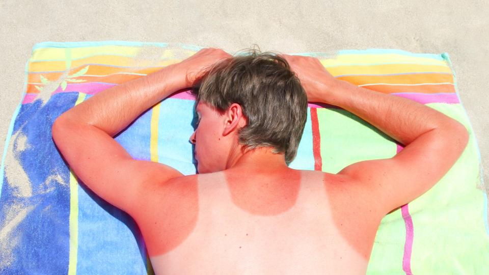 Adult male lies face down on beach towel. He has a vest mark sunburnt on his skin.