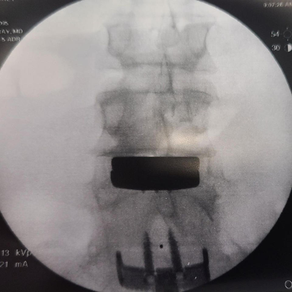 Hart received some new hardware during his spinal surgery.  (hartluck/ Instagram)