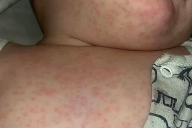 Holly's baby developed a rash once they returned home to the UK
