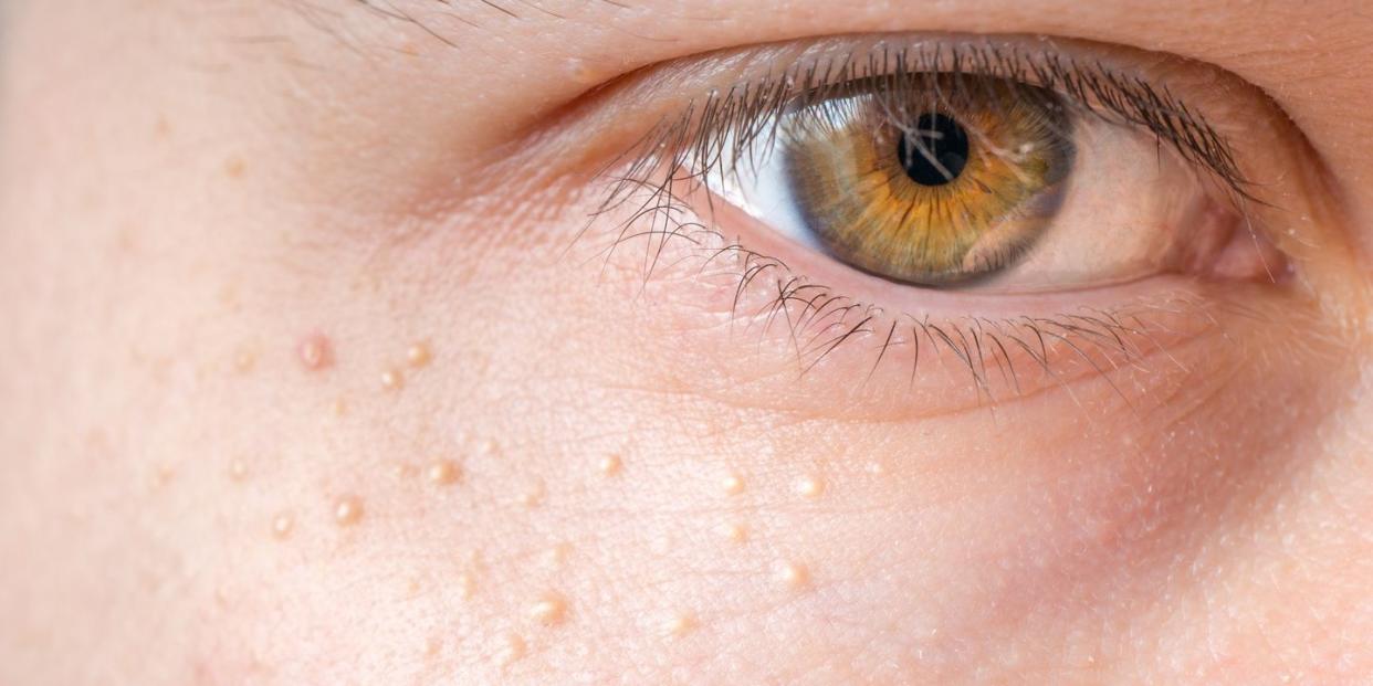 milia milium bumps around eye on skin