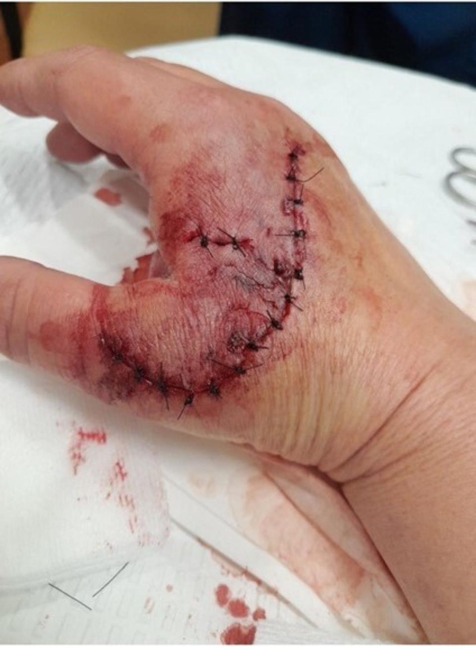 A mixed-breed shepherd attacked Snyder, leaving her needing 16 stitches (pictured) (USPS)