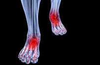 What it means: Undiagnosed stress fractures are a common cause of foot pain. The discomfort can be felt along the sides of the feet, in the soles, or "all over." These fractures -- they often occur repeatedly -- may be caused by another underlying problem, often osteopenia (a decrease in optimum bone density, especially in women over age 50) or some kind of malnutrition, including a vitamin D deficiency, a problem absorbing calcium, or anorexia. More clues: Often you can still walk on the broken bones; it just hurts like heck. (Some hardy people have gone undiagnosed for as long as a year.) 14. Red flag: Feet that are really painful to walk on. What it means: Undiagnosed stress fractures are a common cause of foot pain. The discomfort can be felt along the sides of the feet, in the soles, or "all over." These fractures -- they often occur repeatedly -- may be caused by another underlying problem, often osteopenia (a decrease in optimum bone density, especially in women over age 50) or some kind of malnutrition, including a vitamin D deficiency, a problem absorbing calcium, or anorexia. More clues: Often you can still walk on the broken bones; it just hurts like heck. (Some hardy people have gone undiagnosed for as long as a year.) What to do: See a foot doctor about any pain. If, for example, you've been walking around Europe for three weeks in bad shoes, your feet may simply be sore. But a 55-year-old sedentary woman with painful feet may need a bone-density exam. An X-ray can also reveal possible nutritional issues that warrant a referral to a primary care provider.