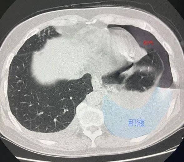 大媽的胸腔裡有大量的氣體和液體。（圖／翻攝自搜狐新聞）