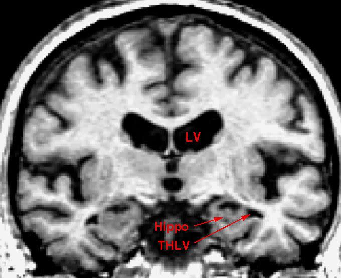 In this file photo, the brain of an older individual shows the early stages Alzheimer's disease. A new study suggestions a gum infection might be linked to the disease.