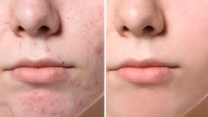 Before-After-Acne-Clear-Skin