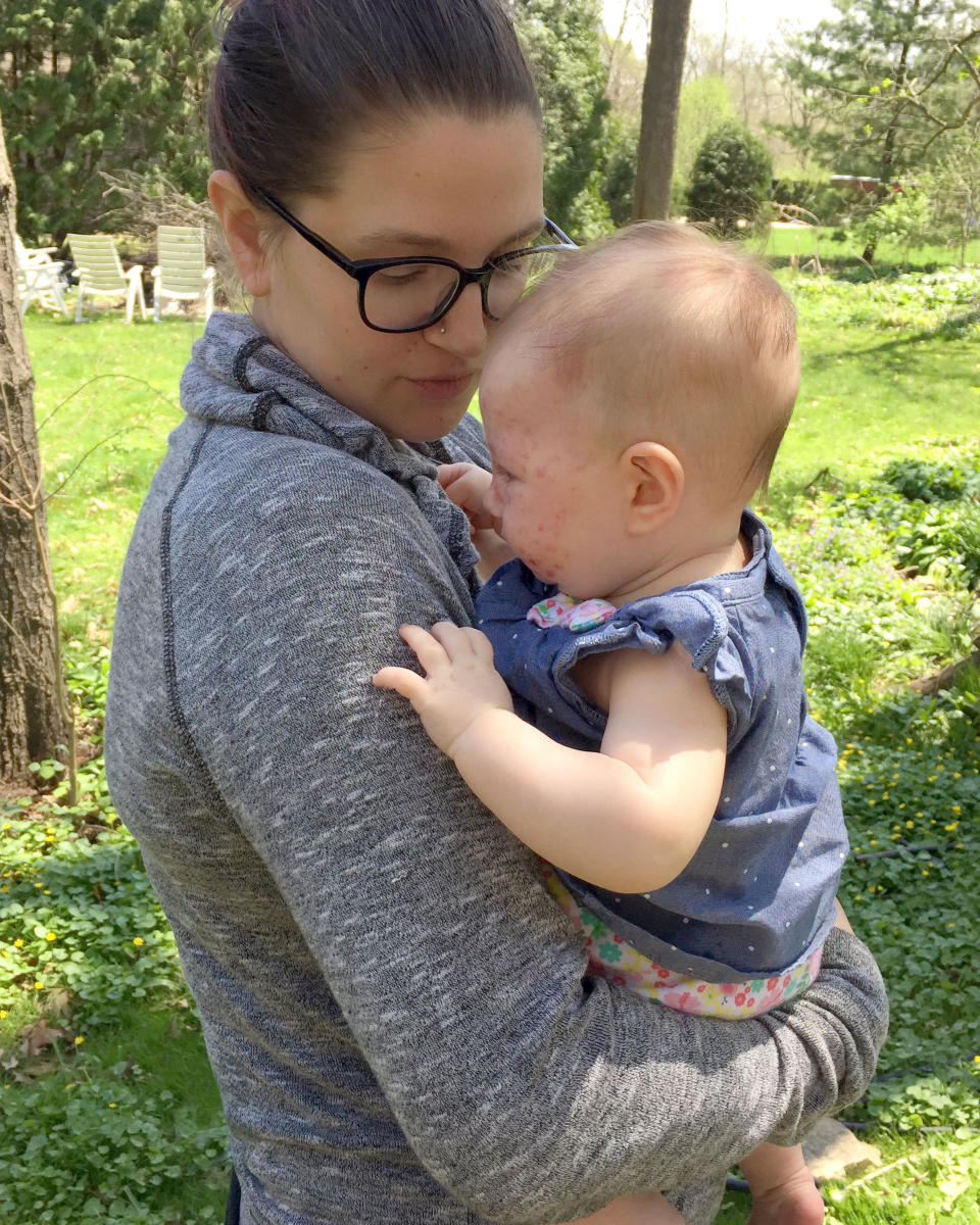 Little Ever was born with the birthmark [Photo: Caters News]