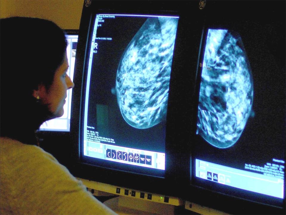 Breast cancer is the most prevalent type of cancer in the UK ( PA)