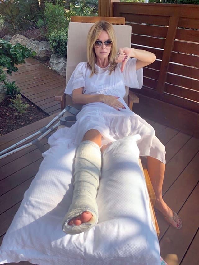 Amanda Holden breaks leg