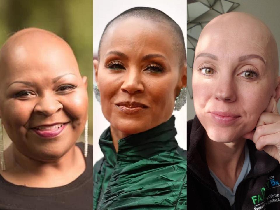 Jada and others with alopecia