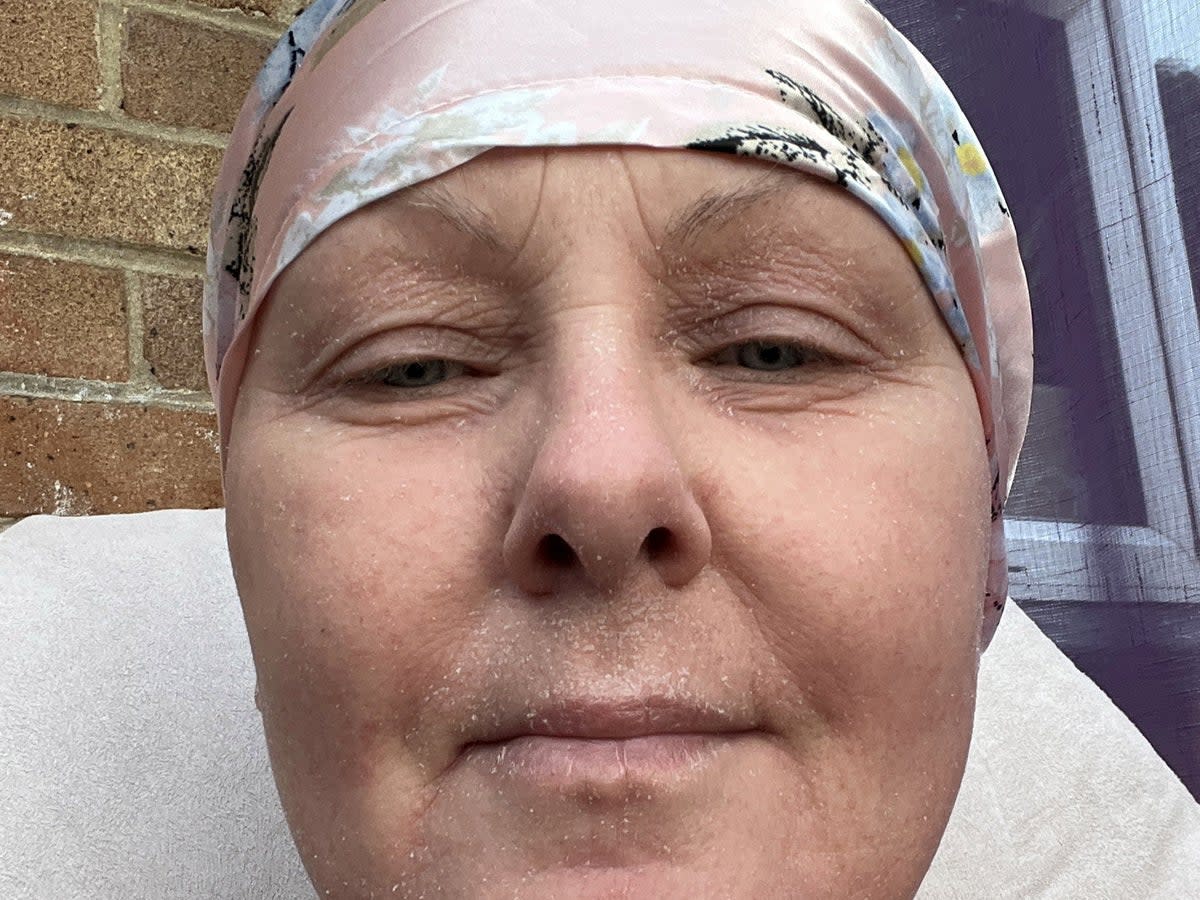 Sharon Shute said she lost nearly all her hair and had to give up work after going through severe topical steroid withdrawal (Sharon Shute / SWNS)