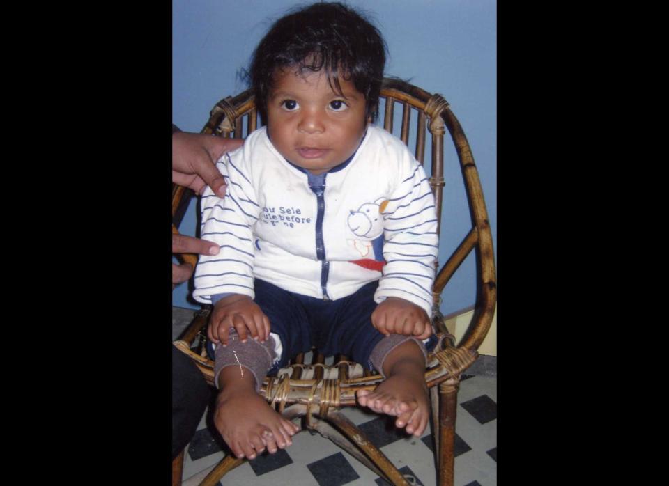 Akshat Saxena had 34 fingers and toes at birth in India in 2010. That set a Guinness World Record for most digits, although doctors later amputated many of them in 2011. 