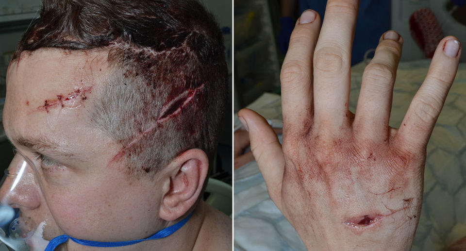 The machete wounds on PC Outten. (PA Images)