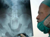 A doctor displays an X-ray of Mohammad Yusuf's stomach that shows a liquor bottle, in Patna, India, Thursday, June 7, 2007. Robbers accosted Yusuf, 30, and shoved the bottle up his rectum when he resisted. The bottle was successfully removed through surgery Thursday. (AP Photo/A.P.Dube, Hindustan Times)