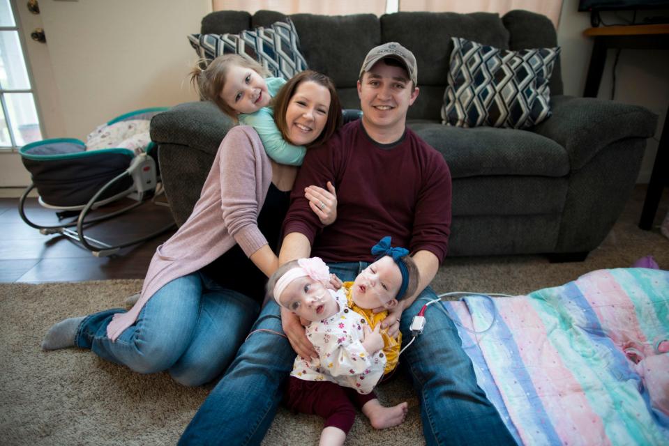 Alyson and Phil Irwin with their conjoined twins Amelia and Sarabeth Irwin at their Petersburg, Michigan home before their separation surgery.