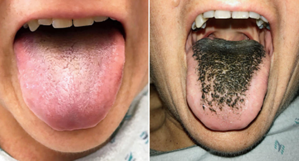 A 55-year-old woman developed a black hairy tongue (right) after taking antibiotic minocycline. She had been in a car accident but the tongue returned to its normal colour after she stopped taking the drug (left). Source: New England Journal of Medicine