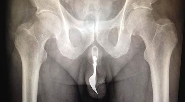 An x-ray of the man's urethra.