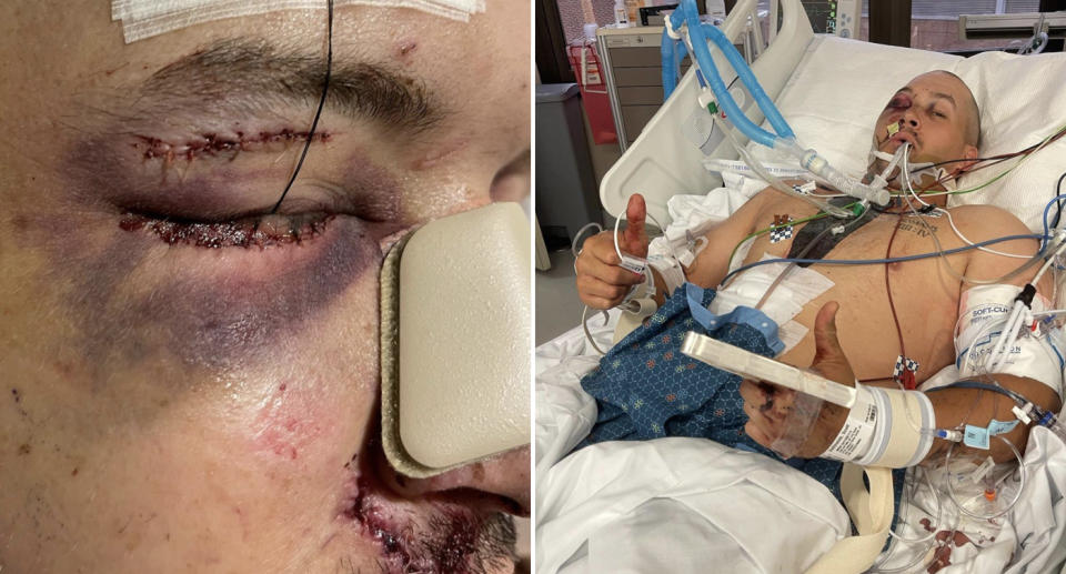 Scott DeShields Jr seen in hospital with injuries after a gun exploded in his face.