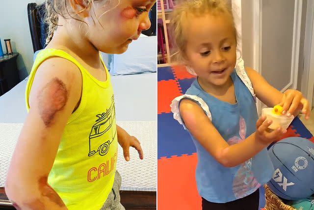 <p>Angela Ribeiro/Instagram</p> Ribeiro's daughter Ava Sue, 4, suffered injuries from a scooter accident in May