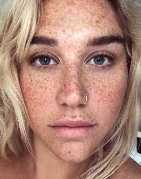 Kesha et ses taches de rousseur