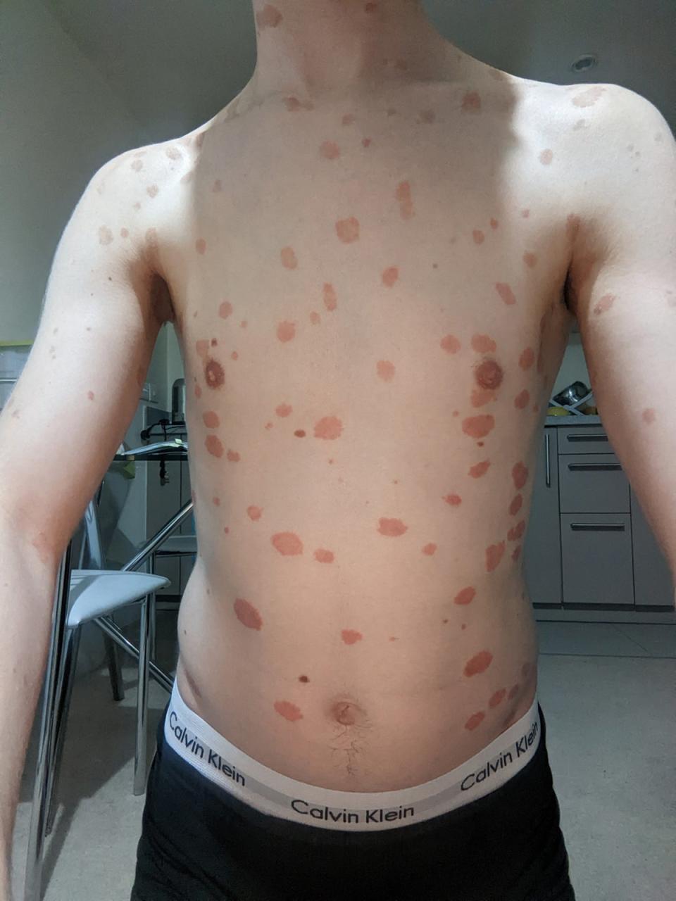 Scot Cunningham, de 27 años, tenía psoriasis en todo el cuerpo (Collect/PA Real Life)