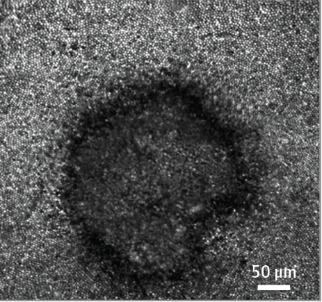 This scan of a woman's left eye shows the 2017 solar eclipse etched on her retina. Mount Sinai New York Eye and Ear Infirmary doctors treated the woman who had retina damage from staring at the eclipse with glasses she thought protected her from harmful rays.