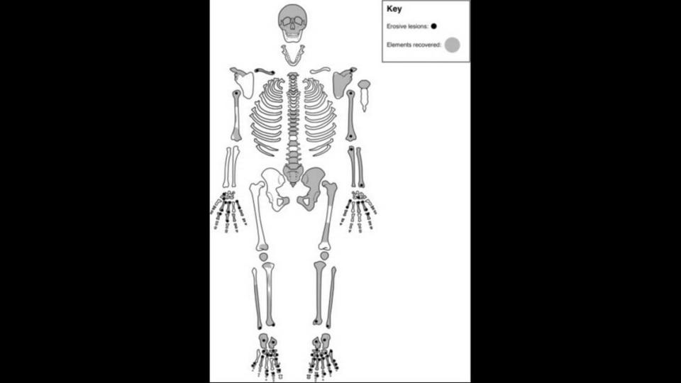 Lesions and holes were found around the joints of the ancient skeleton, a typical presentation of rheumatoid arthritis, the researchers said.