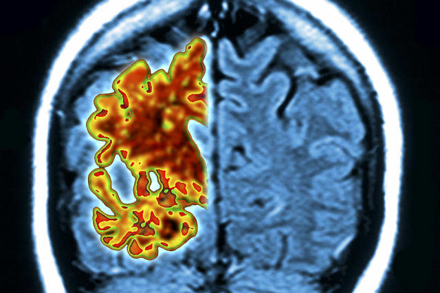 Alzheimer's brain, composite image