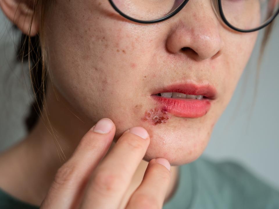 Cold sore caused by herpes simplex virus in the mouth.