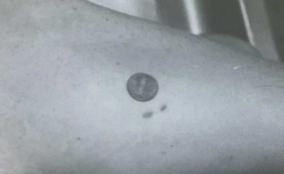 A bite mark photo presented as evidence in the trial of Charles McCrory. (Court exhibit)