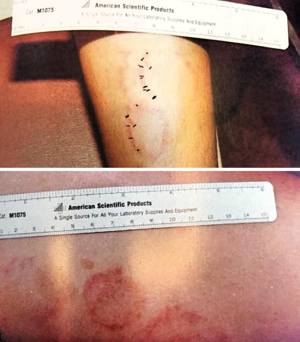 Photographs of bite marks used in the Mark Harward trial.  (court display)