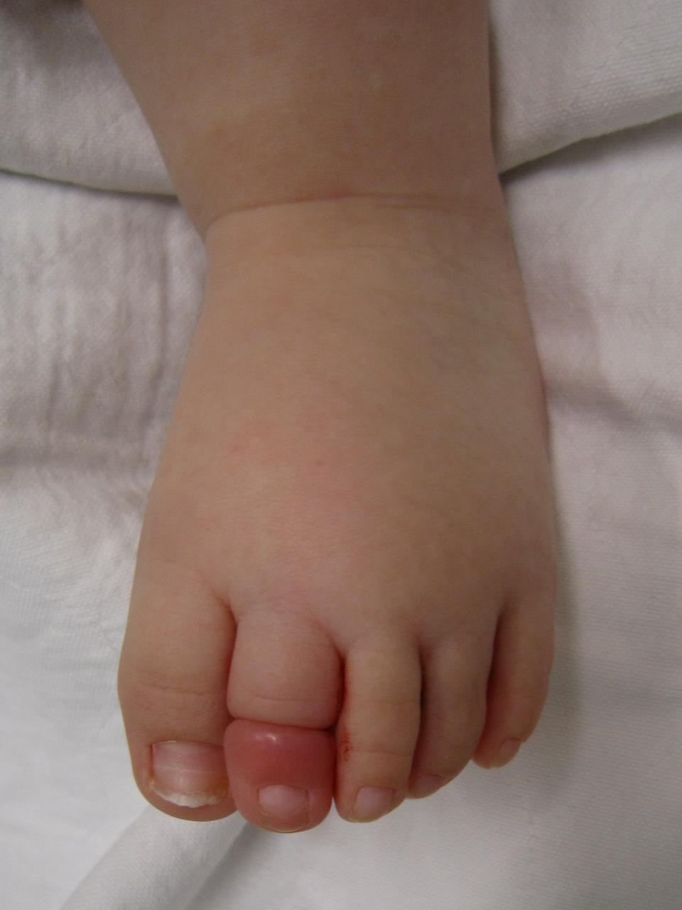 Close-up of a baby's toe resting on a white surface, toes gently curled. There is a hair tightly wrapped around one toe that is red.