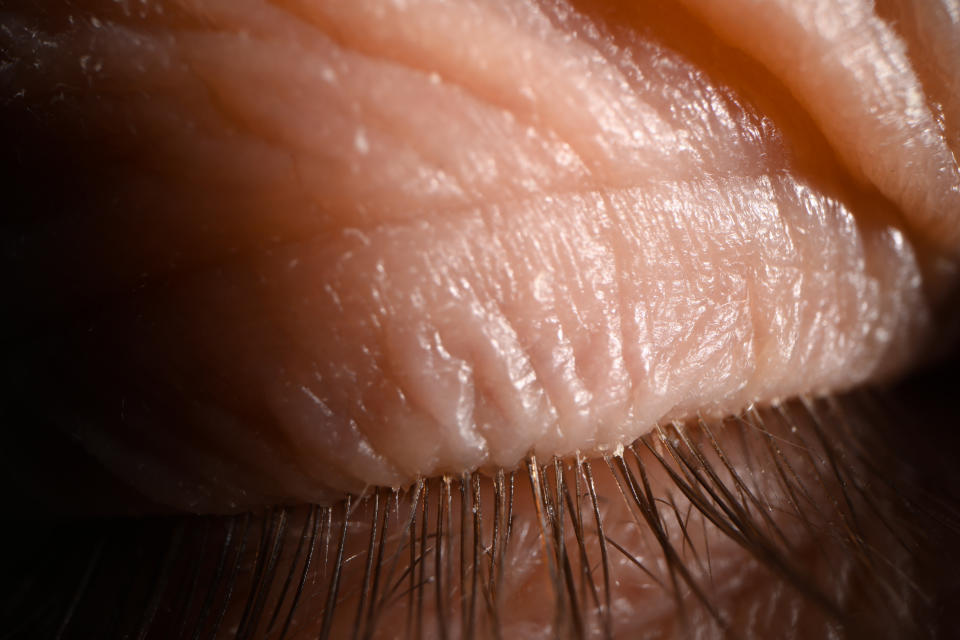 Some people are more sensitive to an overgrowth of demodex than others. (Getty)