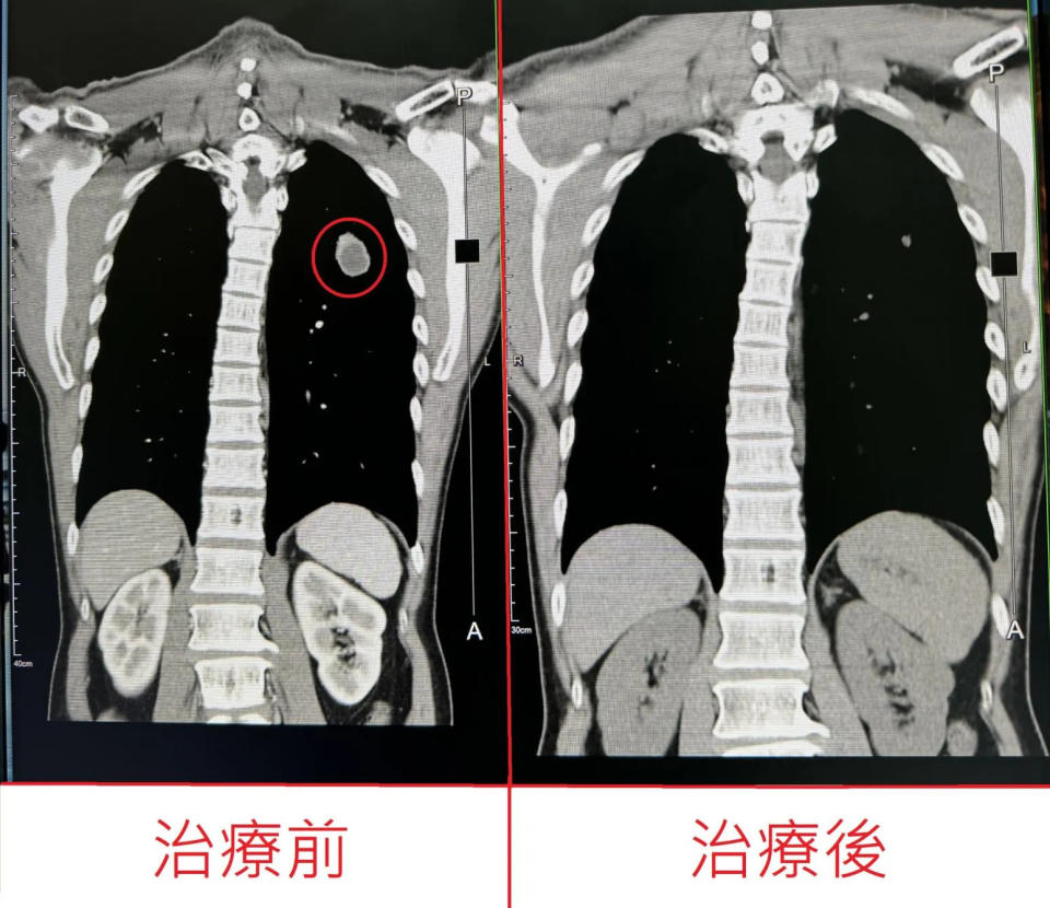 <strong>電腦斷層掃描檢查治療前後-原有左上肺有3.5公分腫塊，治療後成功消滅只剩疤痕。（圖／烏日林新醫院提供）</strong>