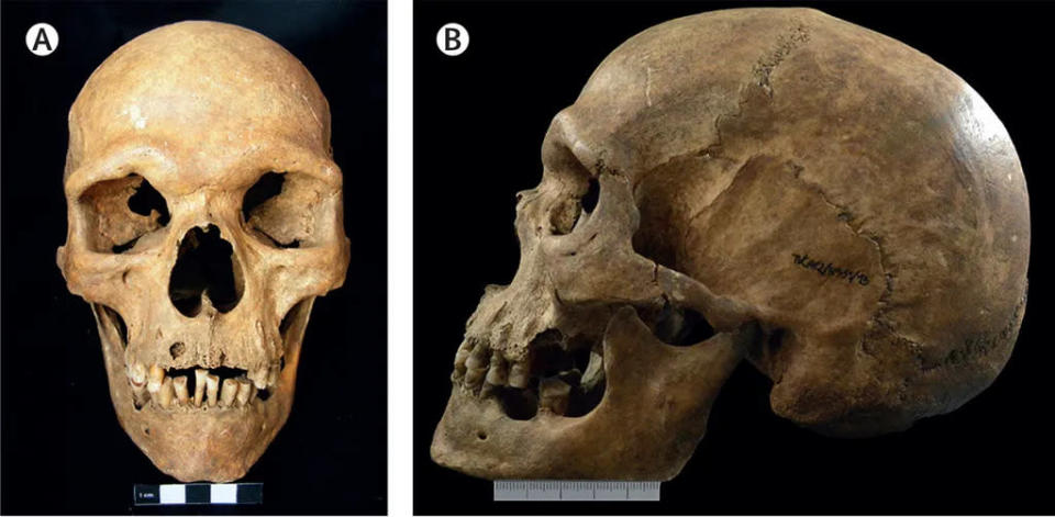 Crânio do homem português com Síndrome de Klinefelter, o mais antigo do mundo a ser identificado com a condição (Imagem: Teixeira et al./The Lancet)