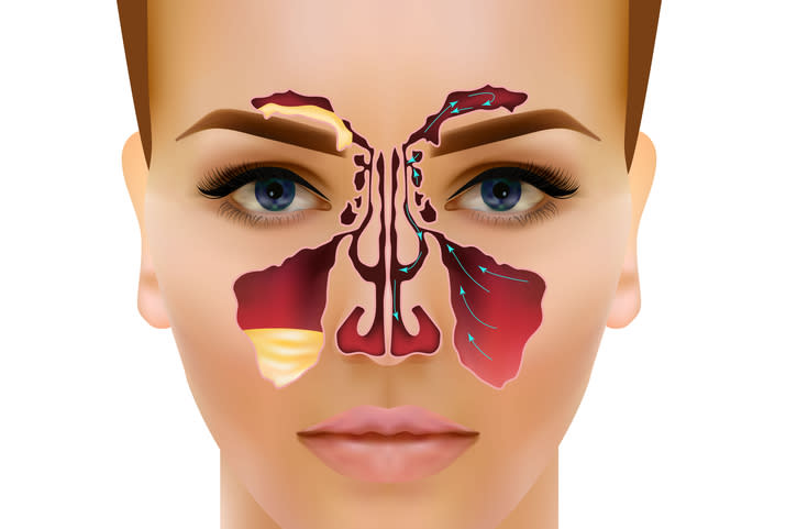 Sinusitis, what it is and why it's so hard to cure